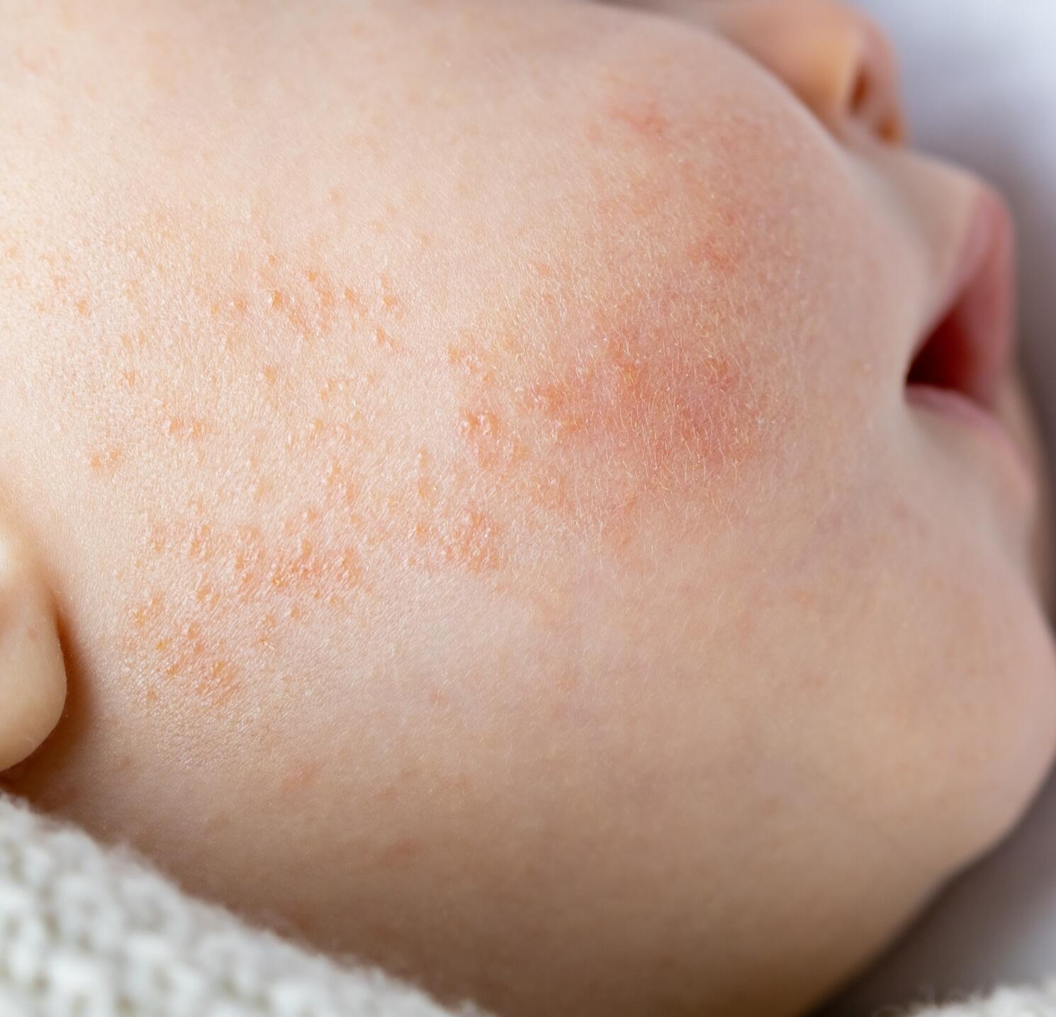 síntomas de la dermatitis atópica
